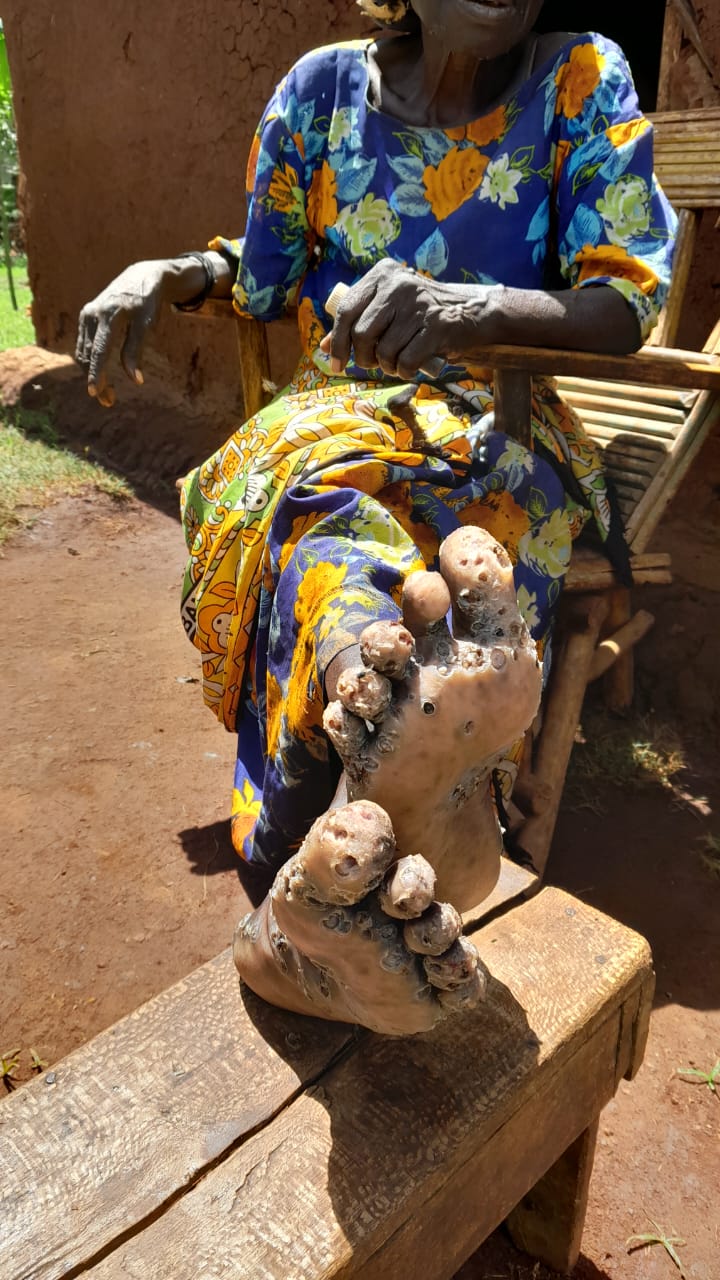 Consolation Mentee Mobilizes the Community to address  Jiggers Problem in Nangili